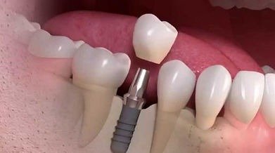 Implante-dentário-qualquer-pesso